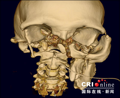 世界罕见缺骨面人造脸术将在四医大进行(组图)
