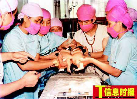 连体姐妹分肝19年生活无恙心有灵犀(图)