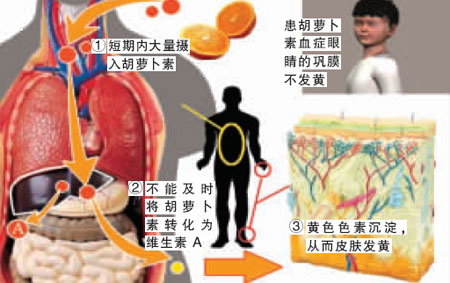 11岁男孩橘子吃太多全身变橘黄色(图)
