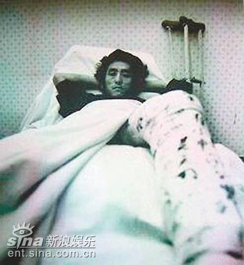 传张艺谋曾被巩俐男友打断腿养伤照片曝光(图)