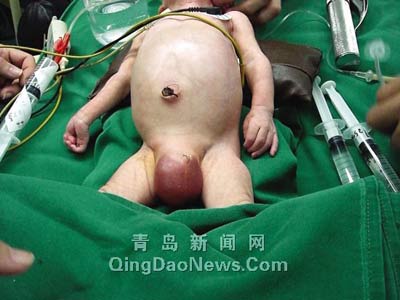 男婴出生四天胃破裂漏气 肚子“充气”像球(图)