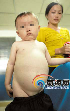 海南2岁男孩腹大如球 饭量很大却不长高(图)