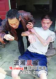 男子患怪病皮肤变硬无法活动(图)