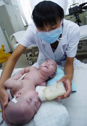 连体姐妹连接部位长16厘米 分离难度大(组图)
