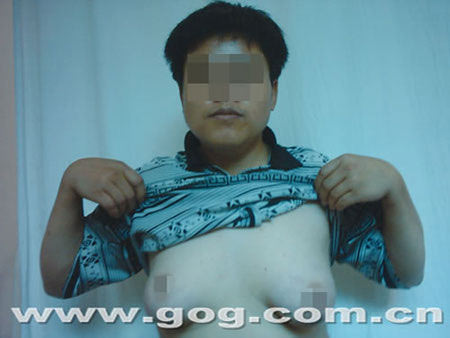 贵州男子10年疯长丰满乳房 5个女友都告吹(图)