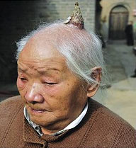 93岁老人头顶长出10厘米长犄角(图)