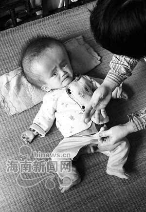 一岁婴儿患怪病脑袋比成人大(组图)