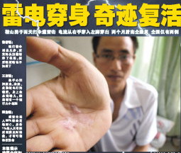 雷电穿身 奇迹生还