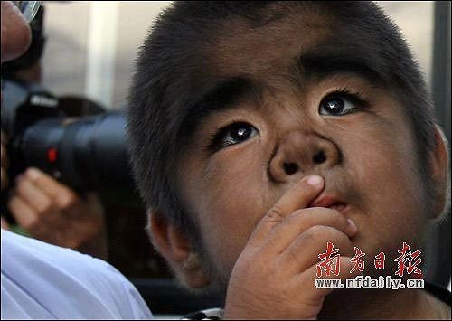 小文才一家的病征十分罕见,初步认为他患上了基因问题导致的“先天性多毛症”。记者 何俊 摄