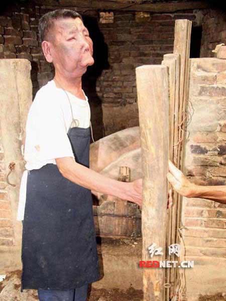 湖南邵阳一男子患怪病长相好似猪八戒(图)