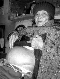 九旬老太身怀死胎58年肚大如篮球(图)