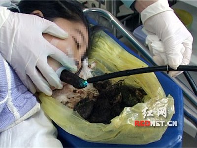 长沙七岁女童患异食癖 四年吞食头发一斤多(图)