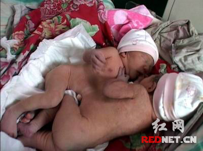 湖南产妇生连体女婴 腹臂相连共用一根脐带