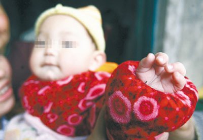 孩子的左手中指缺失。 本报记者 罗伟 摄