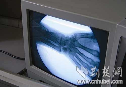 男子体内惊现百余绣花针 注入原因无人知晓