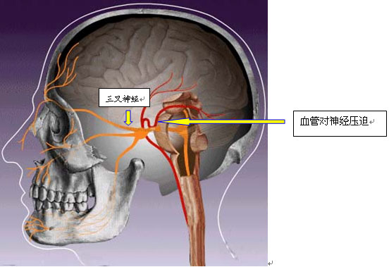 那么为什么会引起三叉神经痛呢?
