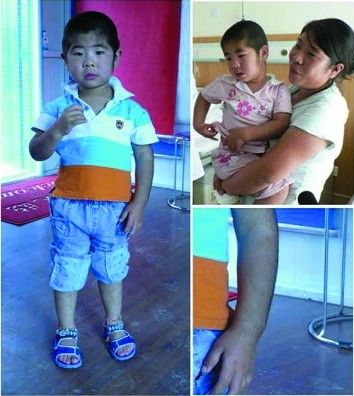 哈尔滨出现毛人家族 两代人体毛长六七厘米