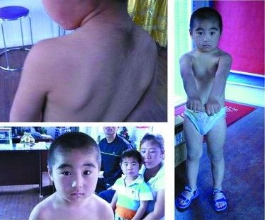 哈尔滨出现毛人家族 两代人体毛长六七厘米