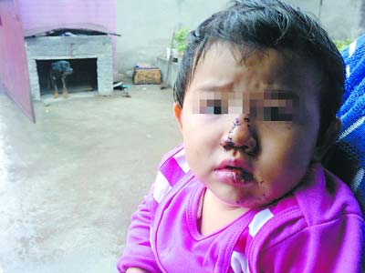 女童鼻子被工厂藏獒撕裂缝15针(图)