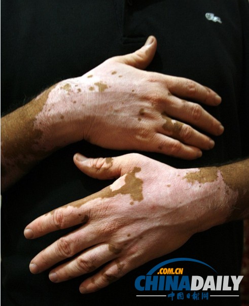 <em>白发</em>变黑将成真 吸血鬼<em>疗法</em>有效治秃顶(图)-变