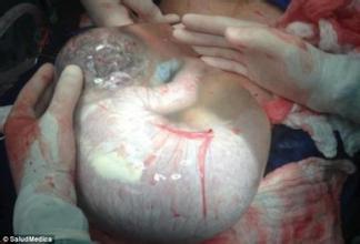 孕妇早产生子 羊水未破宝宝裹在"水球"里(图)