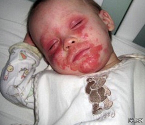 5岁男童生日愿望求死 因患上严重湿疹让他十分