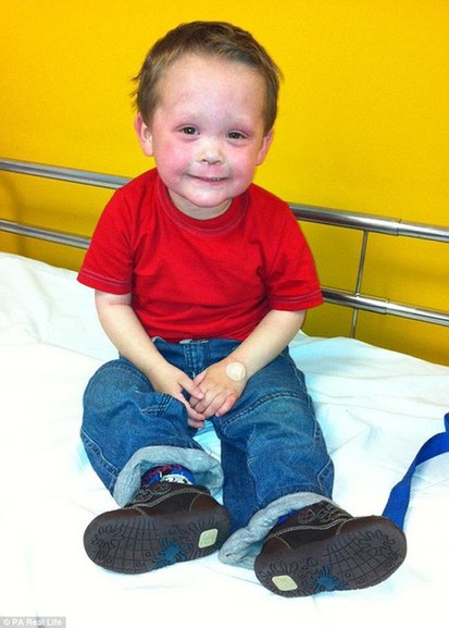 5岁男孩严重过敏脚部皮肤更会裂开到无法走路