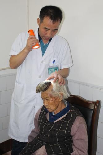 87岁老妇头上黑痣长成独角时时发痒流血(图