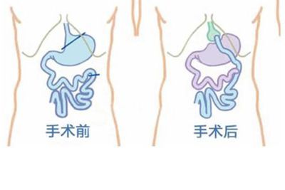 瘦脸9口切胃共减重600余斤切胃咨询真行?削骨一家减肥5张笑天图片