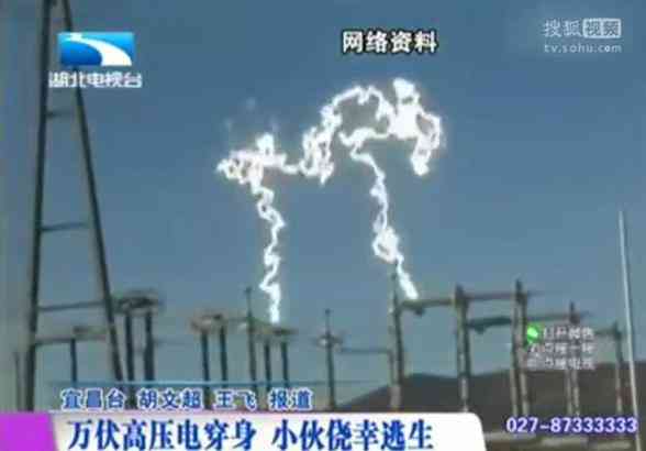 被万伏高压电击穿生还 一个耳朵烧掉 腿部焦黑如碳