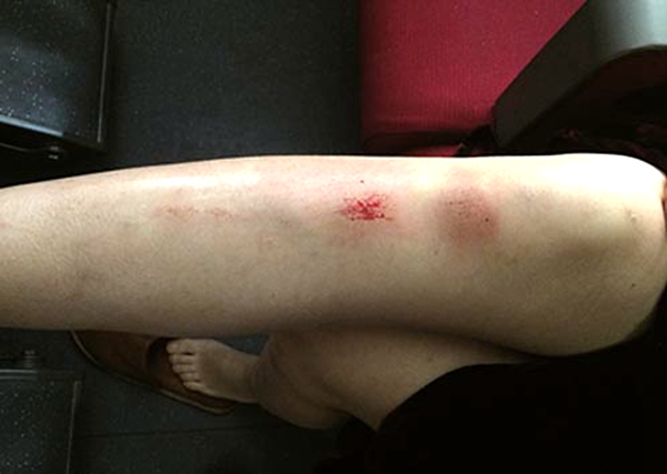 女子掉进站台缝隙磕破腿 网友:点背时放屁都砸脚后跟
