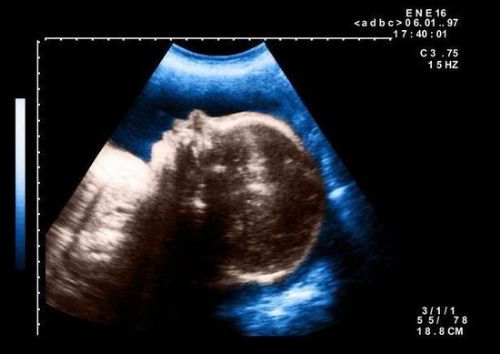  埃及婴儿一只眼睛  可能在子宫里受到了放射物