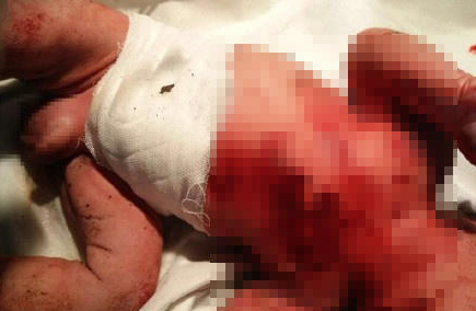  新生儿被竹签刺伤  警方初步排除因身体外伤导