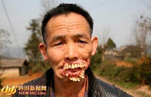 遭狼袭击中“狼牙之毒”被毁容的人 牙齿外翻严重毁容样貌吓人至今未娶妻(图)--东北网娱乐