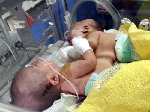  江西连体男婴分离  刚出生时胸部连体肝脏相连