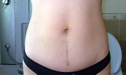 女子 7年5次剖腹产  子宫已薄如一层纸几乎透明