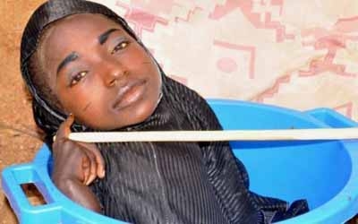 女孩患怪病住盆里 只剩下头部和胸腹!怎么治?