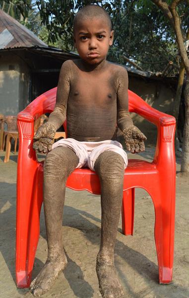 孟加拉国8岁男童患罕见皮肤病 身体长满灰色鳞片