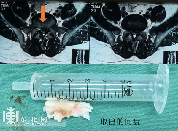 腰间盘突出微创手术是什么原理_腰间盘突出微创手术图