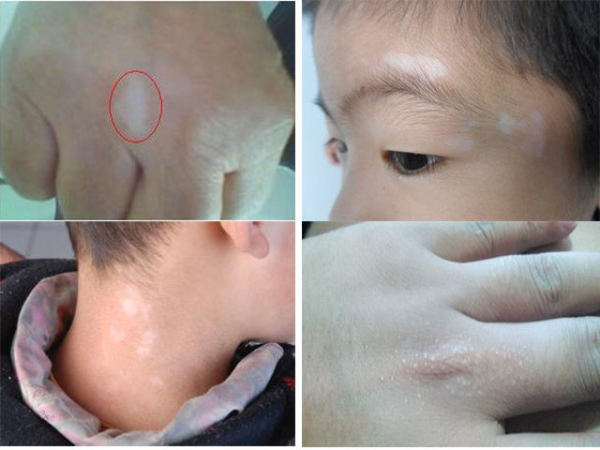 脸部白斑涂抹什么药 00300669210_c86d2a9b.jpg