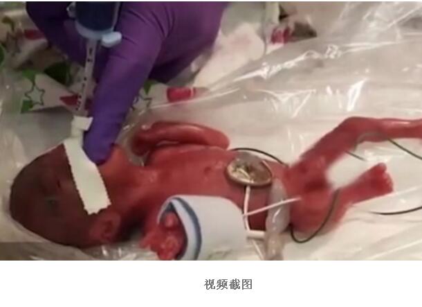 奇迹!最小存活婴儿出院 出生时体轻如苹果