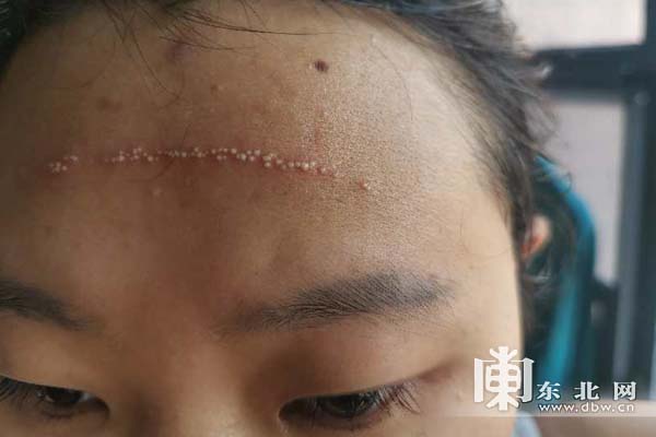 前额因为汗水和三层帽子长期不透气长了一串泡和三道压痕伤