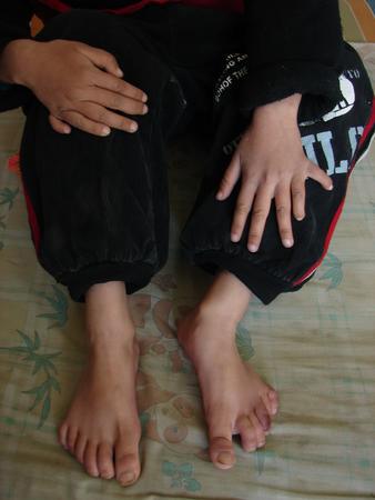 内蒙古9岁女童手脚各长六指(图)