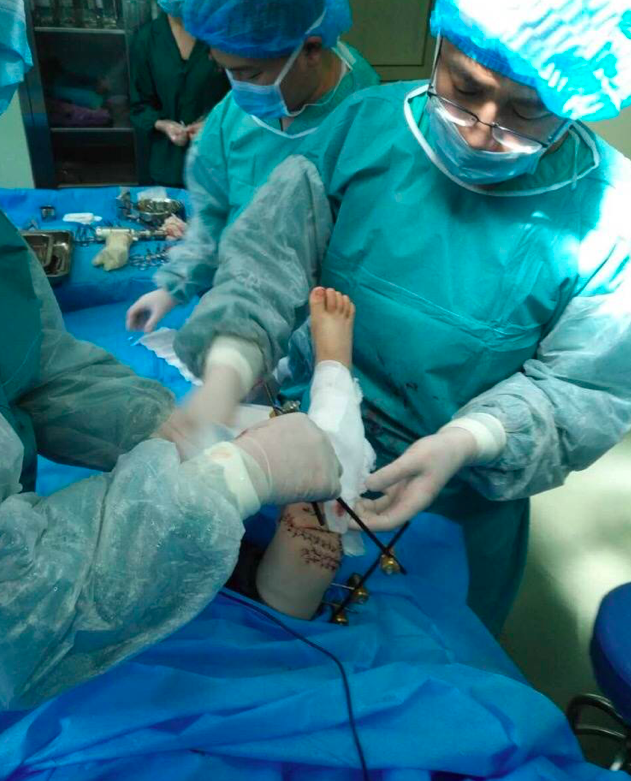 女子砍断2岁儿子右腿男童断肢已成功对接再植
