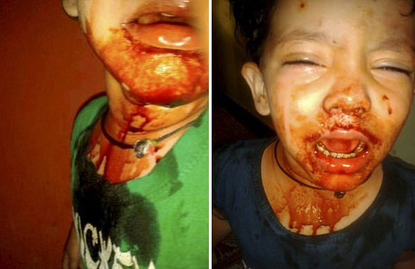 的嘴巴,耳朵和眼睛几乎每天都会流血,被怀疑患有一种极其罕见的血汗症