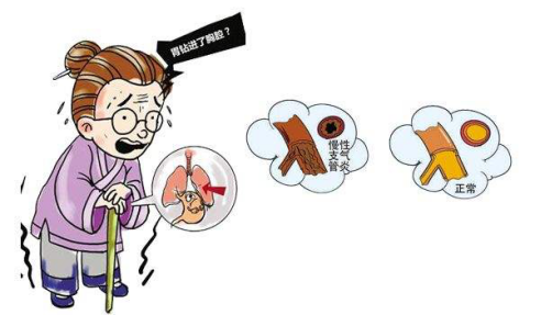 老慢支最先的症状就是咳嗽,这主要是气管,支气管分泌物聚积或者支气管