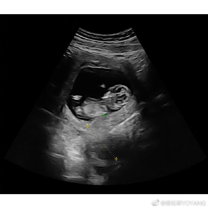 b超怀孕一个月图片