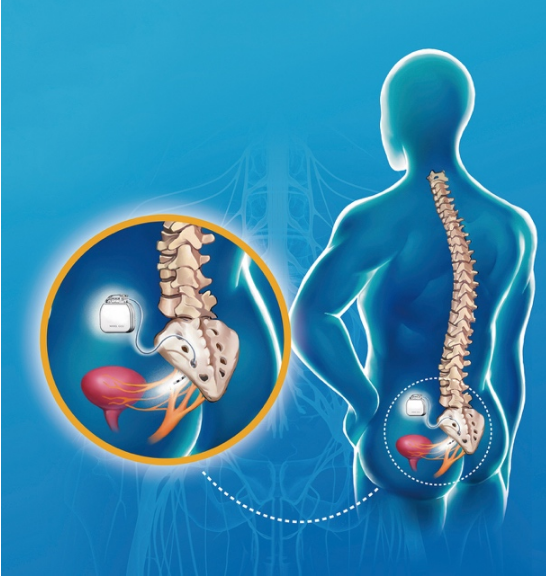 解决尿便障碍难题 骶神经调控疗法应运而生