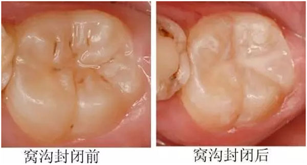 黑龙江省口腔病防治院预防科适龄儿童免费六龄齿窝沟封闭活动开始啦