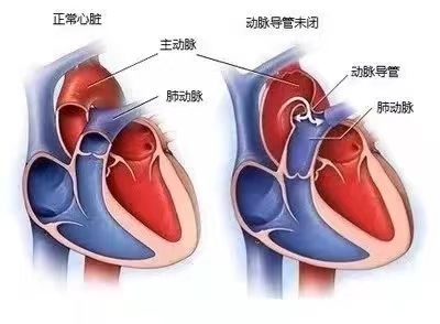心脏有漏洞微创来补心哈尔滨市第二医院成功完成经皮动脉导管未闭介入